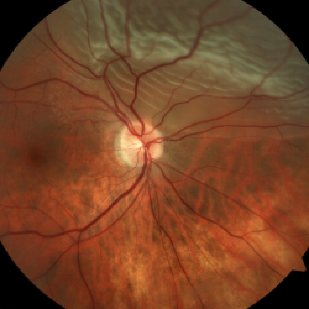 retina detachment