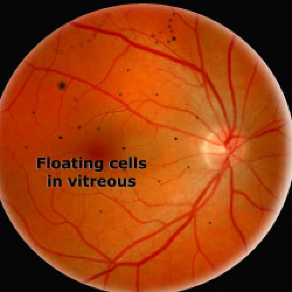 new research on eye floaters