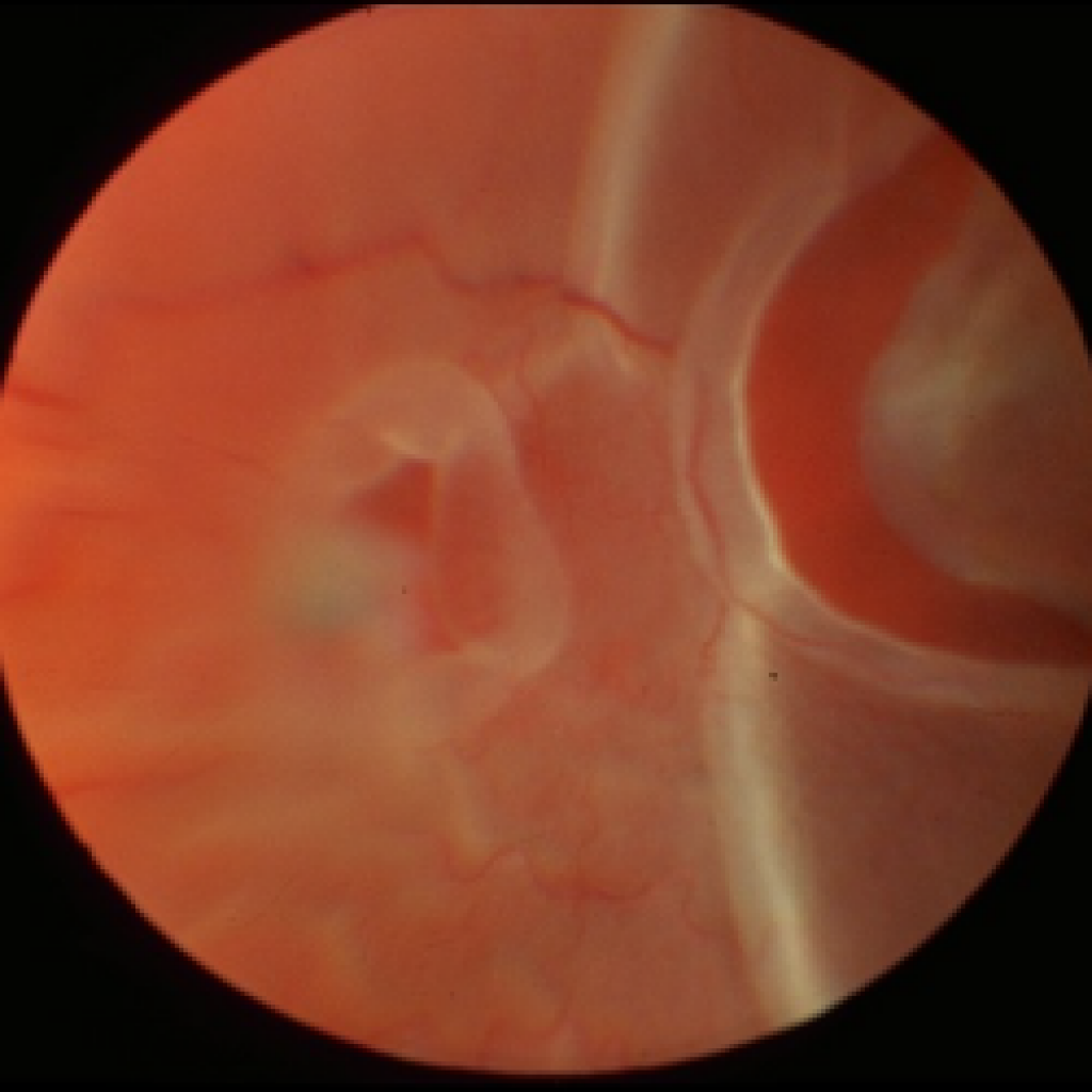 hole in retina symptoms